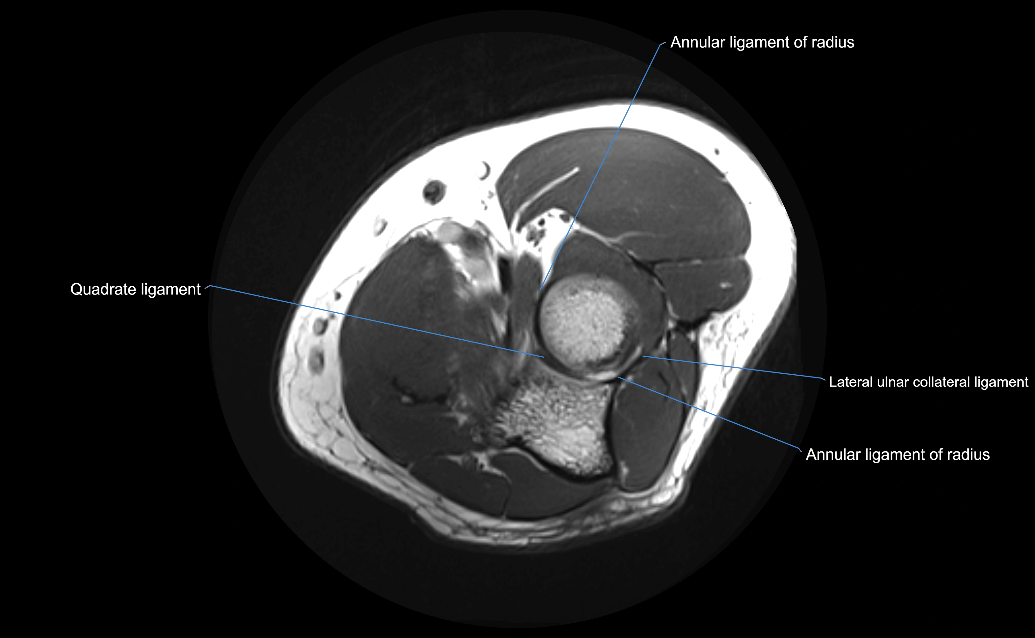 MRI elbow ligaments axial cross sectional anatomy 3T  radiology  image-img-00001-00019.webp